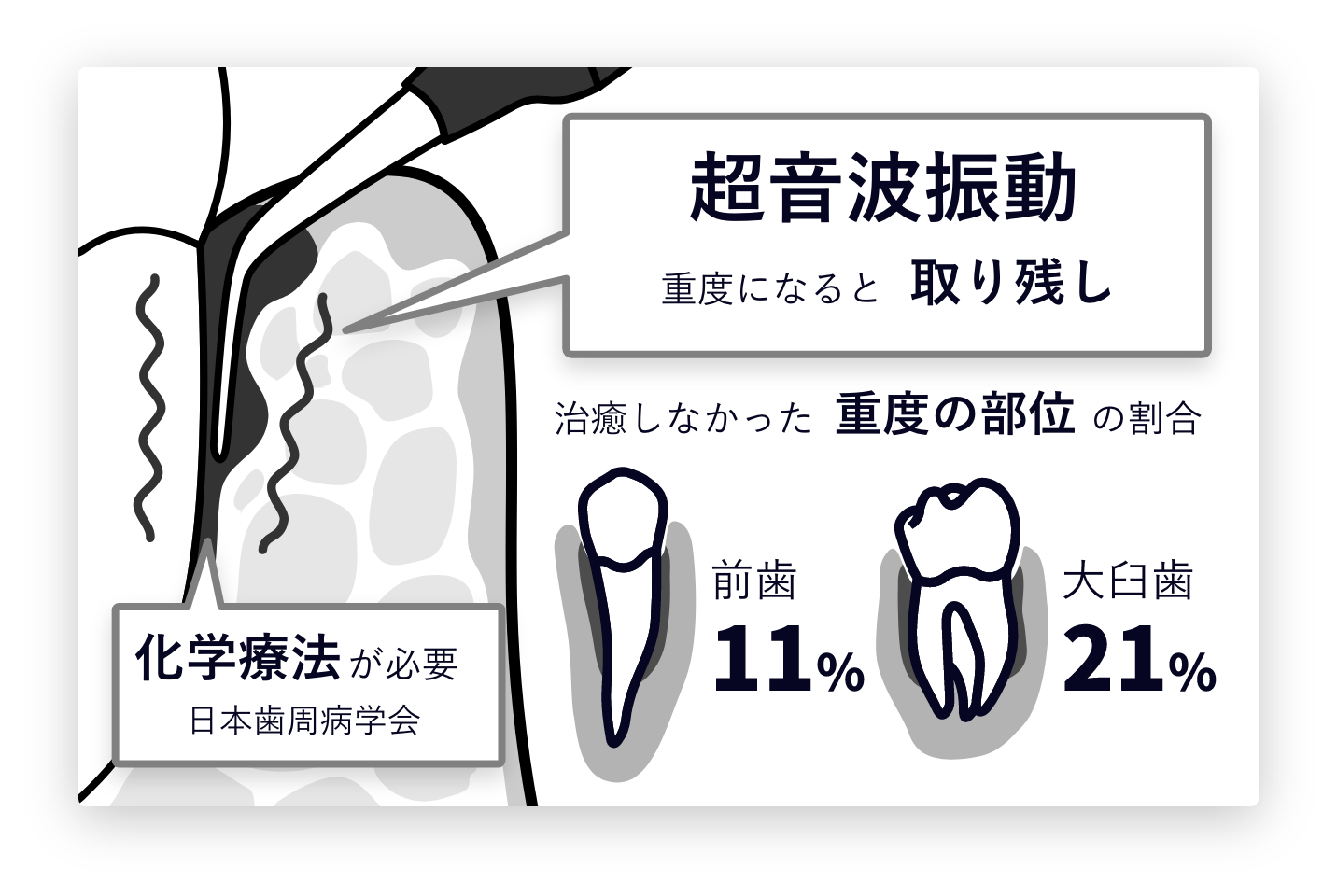 超音波振動のみでの治療イメージイラスト