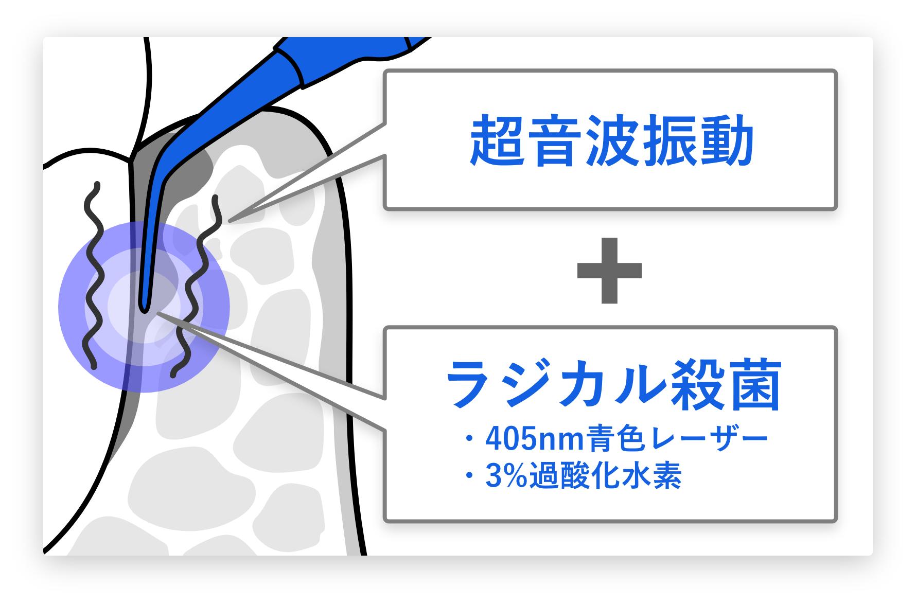 超音波振動+ラジカル殺菌での治療イメージイラスト