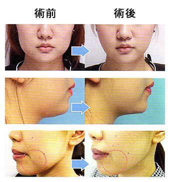 術前・術後イメージ