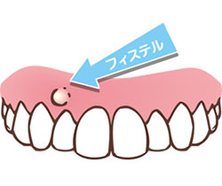 付け根 口内炎 歯茎 歯茎が赤い・腫れていると歯肉炎？原因と対策